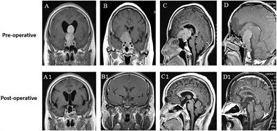 Surgical management of giant pituitary adenomas: institutional experience and clinical outcomes of 94 patients